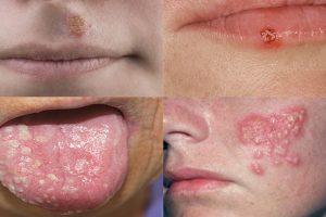 Uçuk (Herpes Simplex) Tedavisi